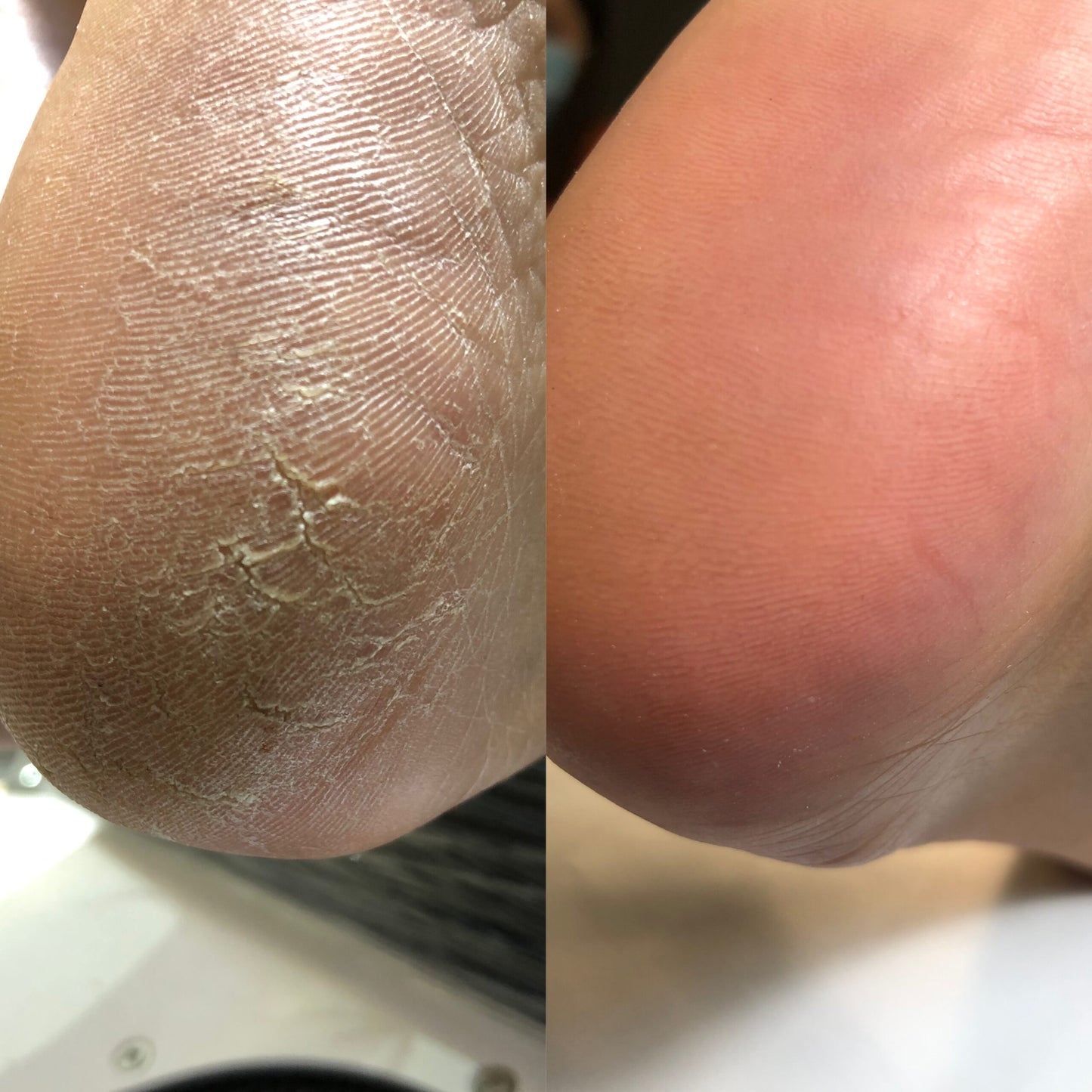 CALLUS REMOVER FOR Pedicure PODOLOGY BY NOTD 100ml
